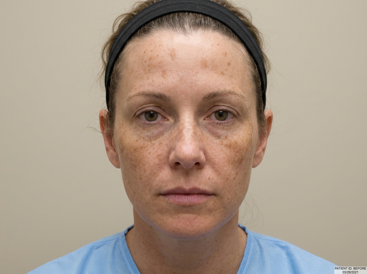 BBL HEROic Pigmentation & Sun Spots Before